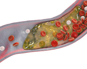 LipoProtein Plus Cardiovascular